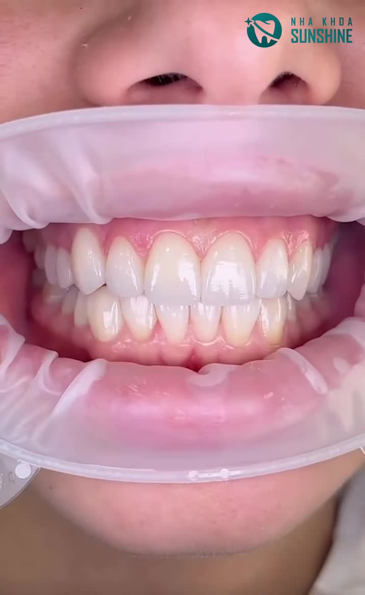 DÁN SỨ MÀ SỢ DÀY, SỢ GIẢ? XEM NGAY TIÊU CHUẨN VENEER TẠI SUNSHINE!