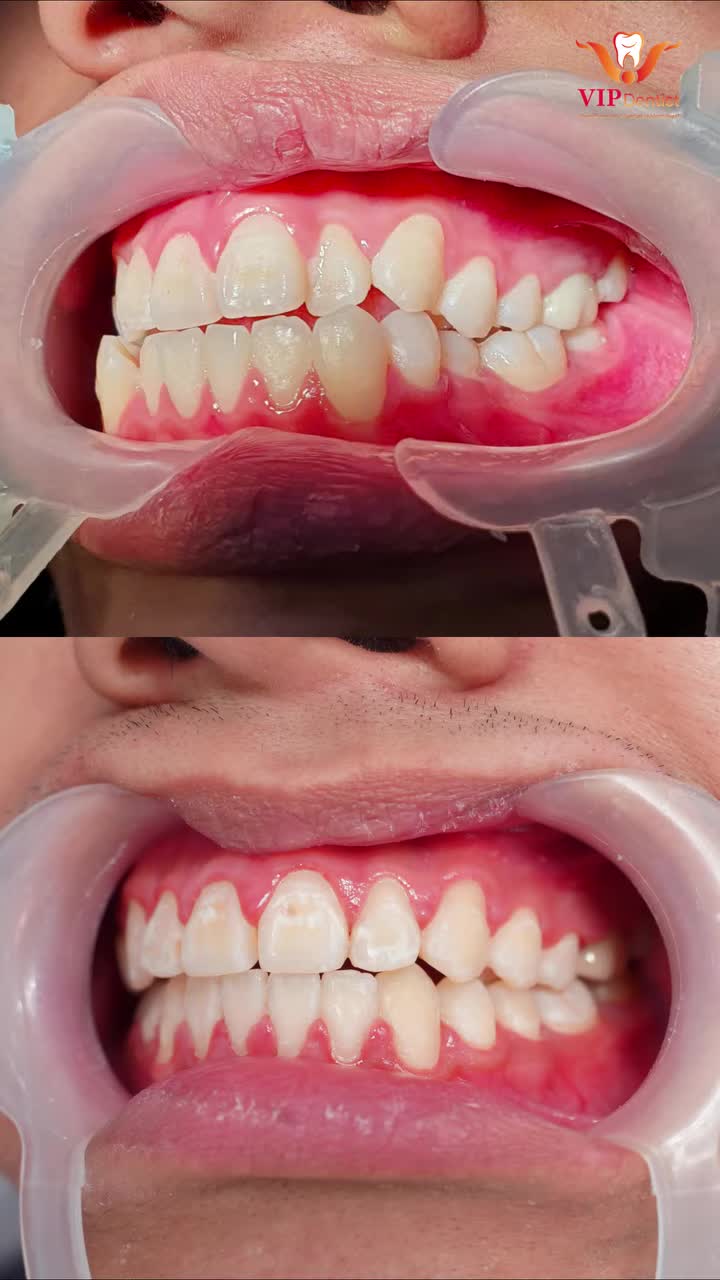 CHỈNH KHỚP CẮN - SỬA NỤ CƯỜI!