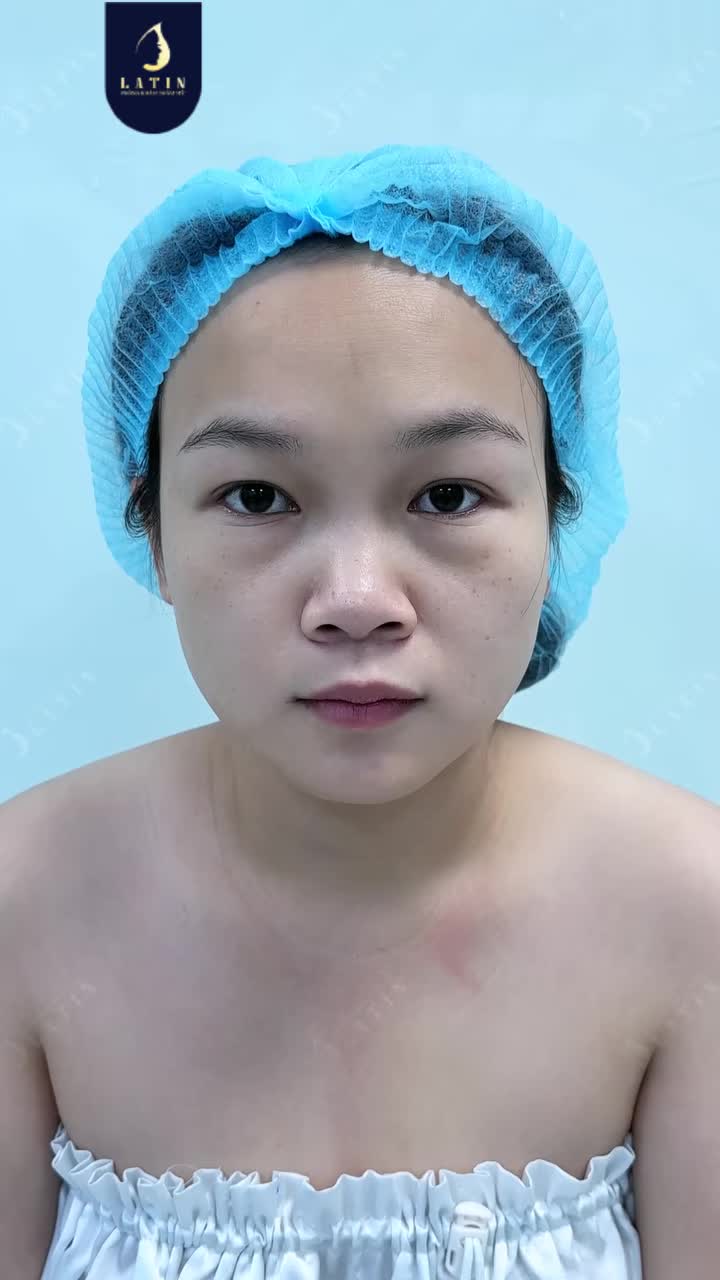 COMBO MŨI CAO SANG - M.Í DƯỚI CĂNG MỊN