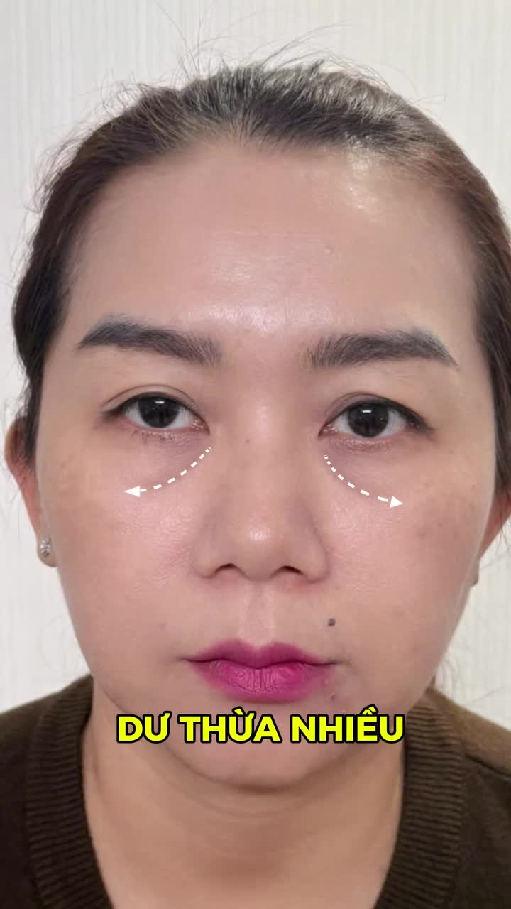 ĐÁNH BAY BỌNG MẮT VÀ SỤP MÍ CHỈ VỚI 1 COMBO