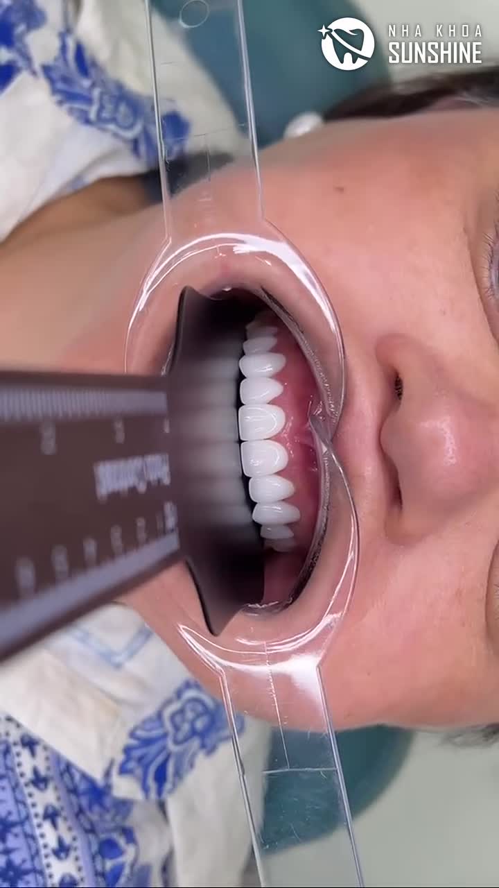 "CẬN CẢNH NỤ CƯỜI SAU 2 NGÀY — XEM NGAY ĐỂ THẤY SỰ KHÁC BIỆT!"