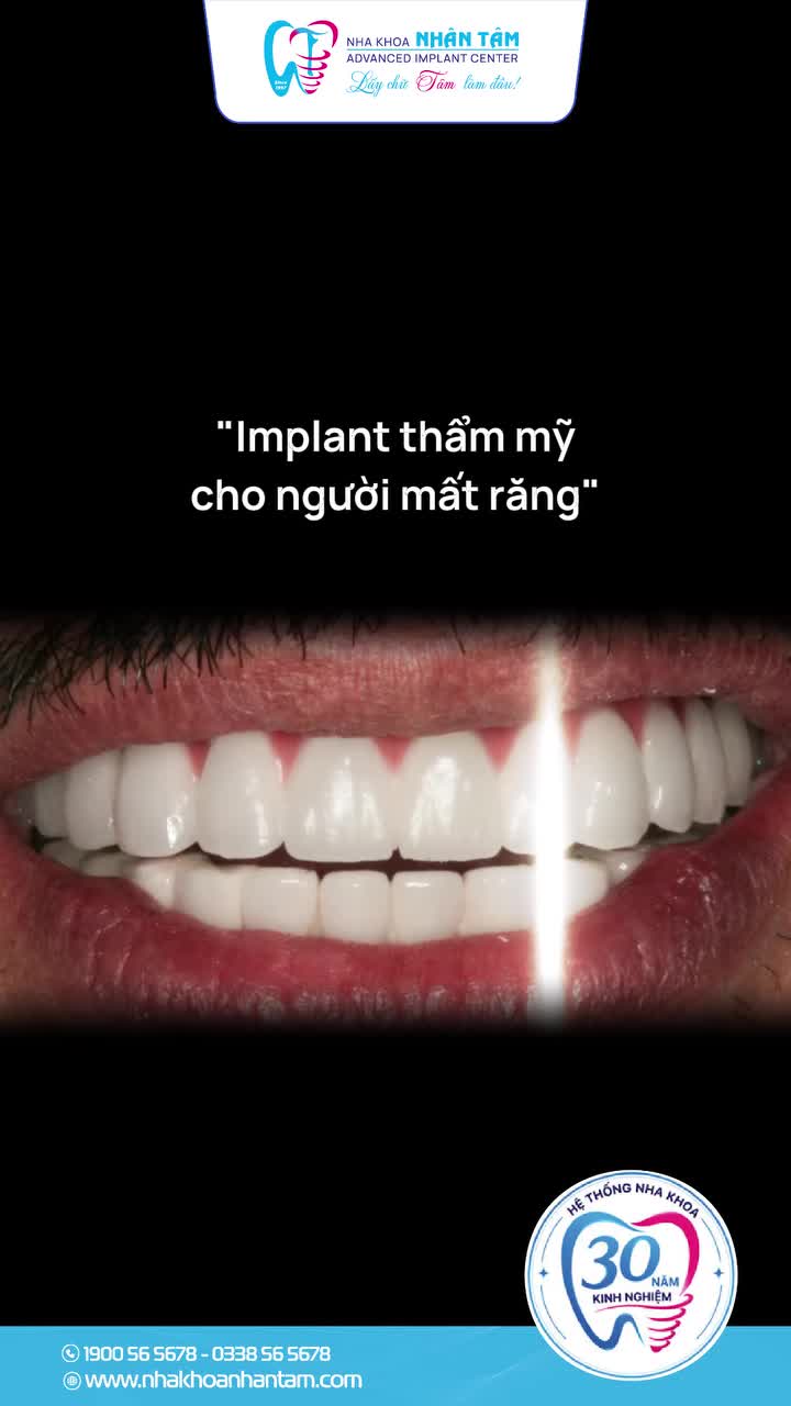 IMPLANT THẨM MỸ – TÌM LẠI NỤ CƯỜI CHO NGƯỜI MẤT RĂNG