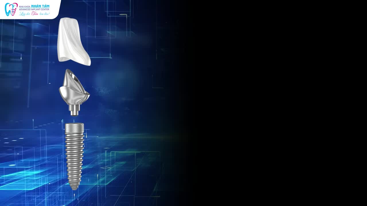 LÀM IMPLANT, CHỌN TRỤ TỐT THÔI ĐÃ ĐỦ?