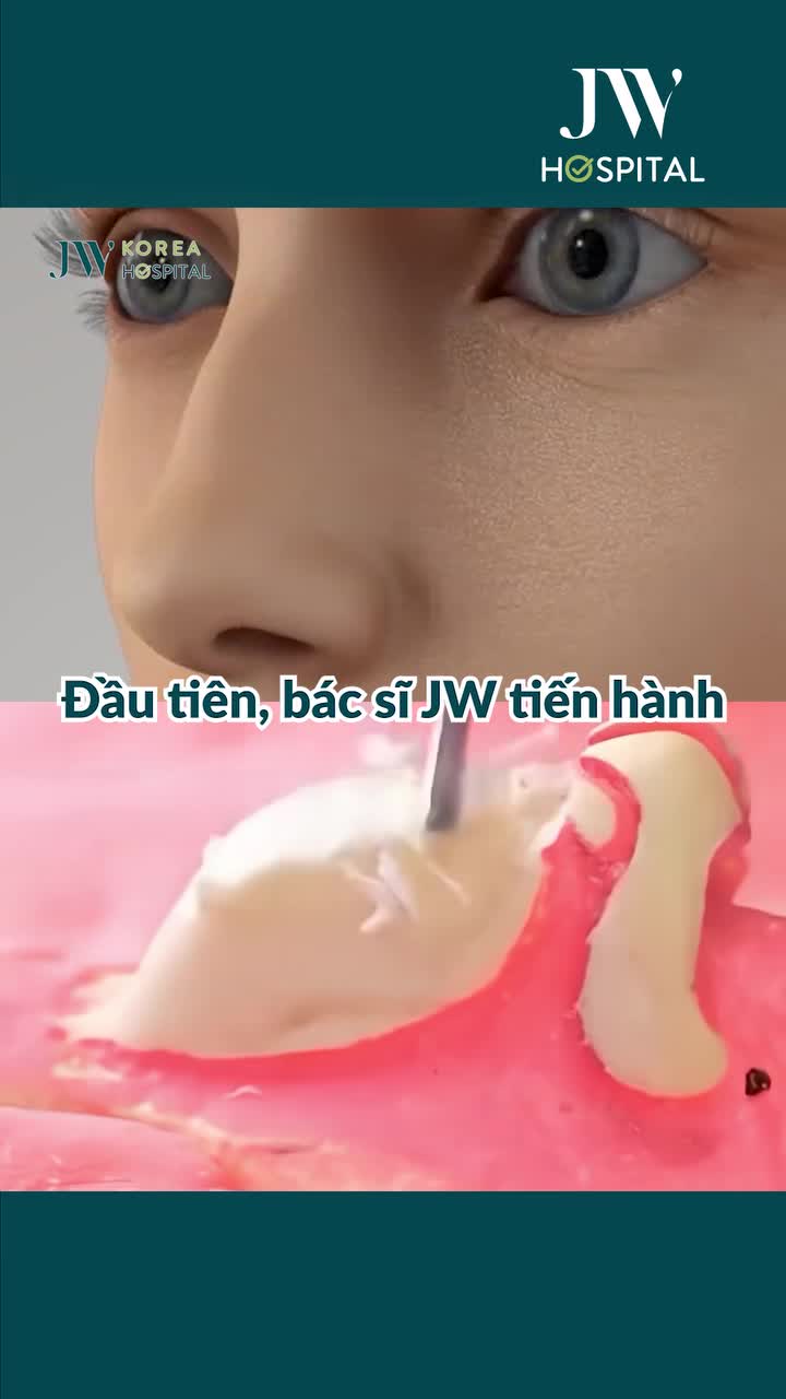 LỘ DIỆN QUY TRÌNH CHỈNH SỬA MŨI GỒ AN TOÀN, TỰ NHIÊN TẠI BỆNH VIỆN JW