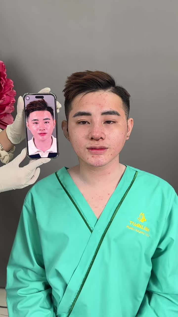 Mũi cấu trúc nam sau phẫu thuật
