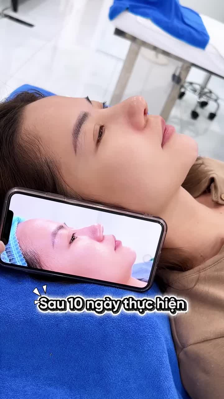 CHIA TAY MŨI CHỈ CŨ, F5 GÓC NGHIÊNG VỚI COMBO M.Ũ.I SAU 10 NGÀY