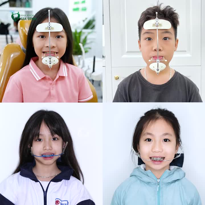 DÙ VƯỚNG VÍU VỚI KHÍ NỤ NIỀNG RĂNG, NHƯNG CÁC BẠN NHỎ VẪN KIÊN TRÌ ĐẾN CÙNG