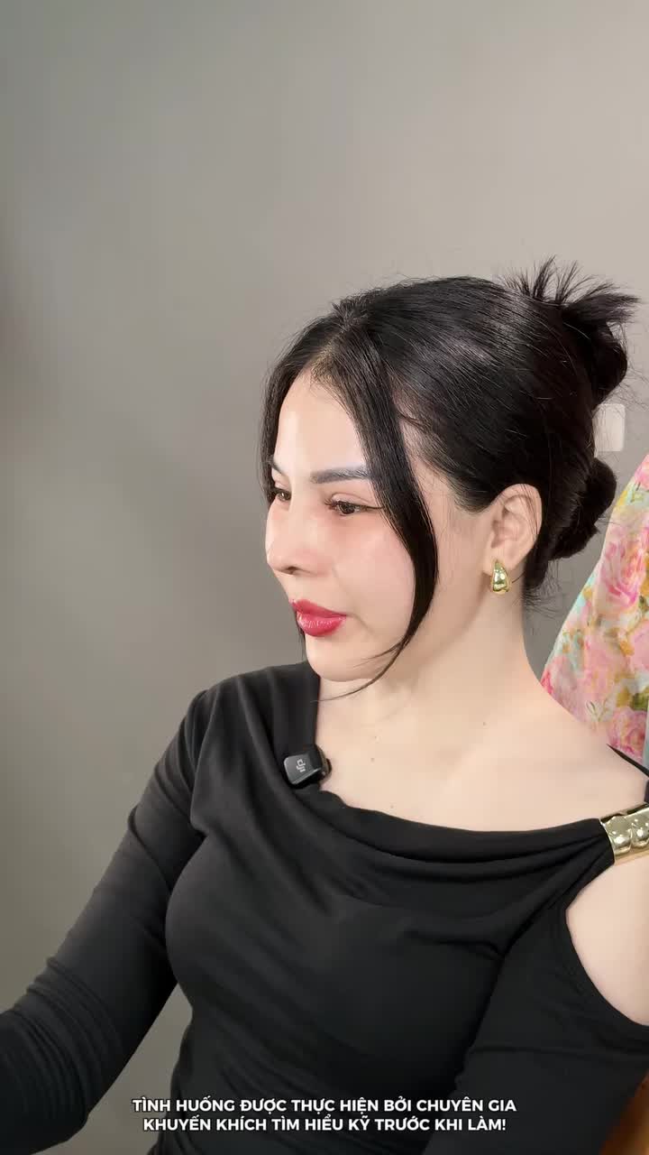 MŨI CẤU TRÚC SỬA LẠI SAU 10 NGÀY – DÁNG MŨI DẦN THANH THOÁT, GƯƠNG MẶT THÊM HÀI HÒA