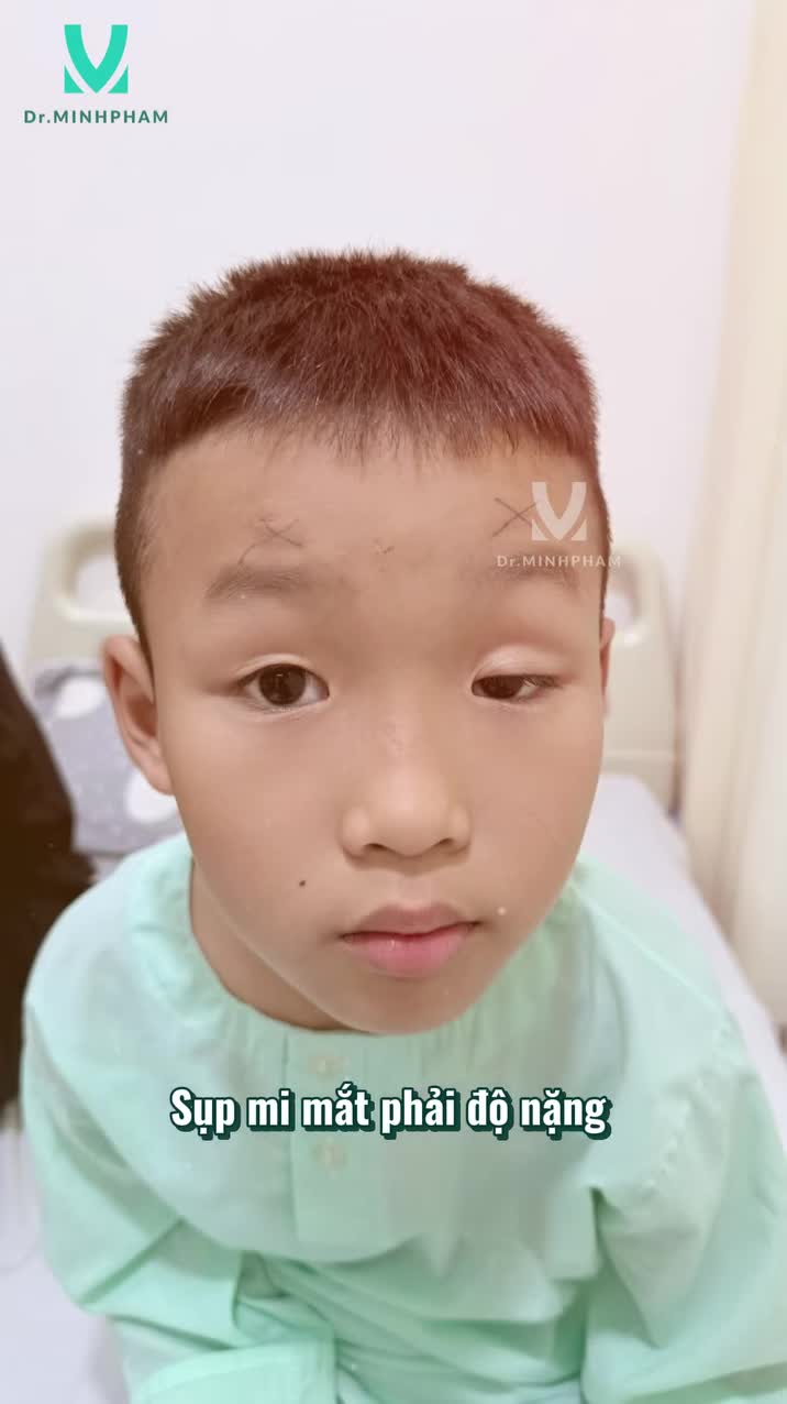 SAU 3 THÁNG TREO MI VCT – ĐÔI MẮT CỦA BÉ TRỌNG BẢO TỰ TIN HƠN ĐỂ QUAN SÁT THẾ GIỚI