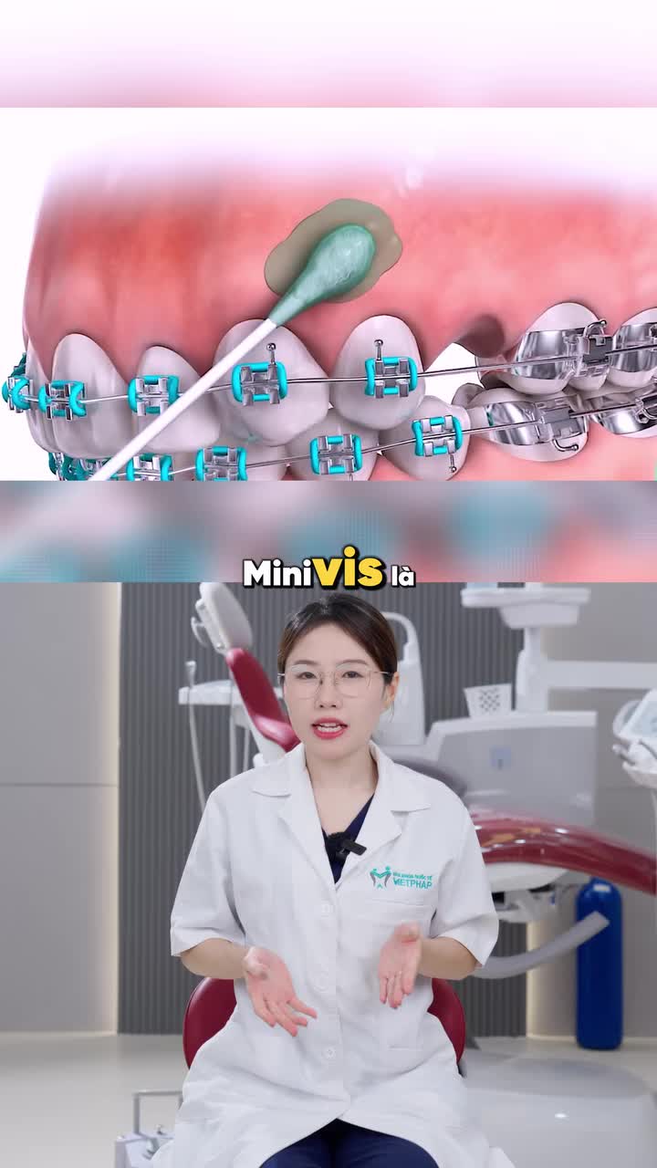 LÚC NÀO THÌ CẦN CẮM MINIVIS KHI NIỀNG RĂNG?