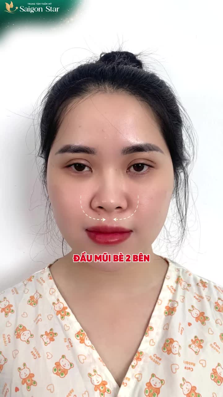 SAU 2 TUẦN NÂNG MŨI CẤU TRÚC DR. HOẠT LÊN HÌNH GÓC NÀO CŨNG XINH