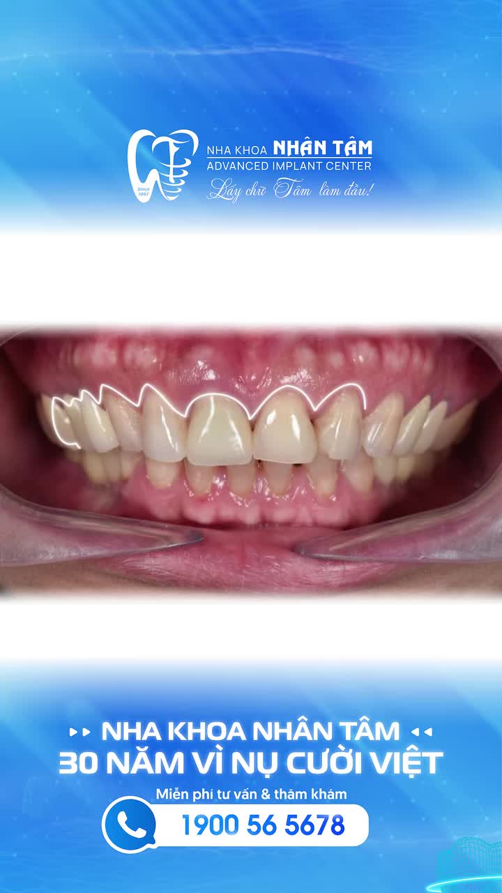 ĐIỀU CHỈNH NƯỚU KẾT HỢP BỌC RĂNG SỨ