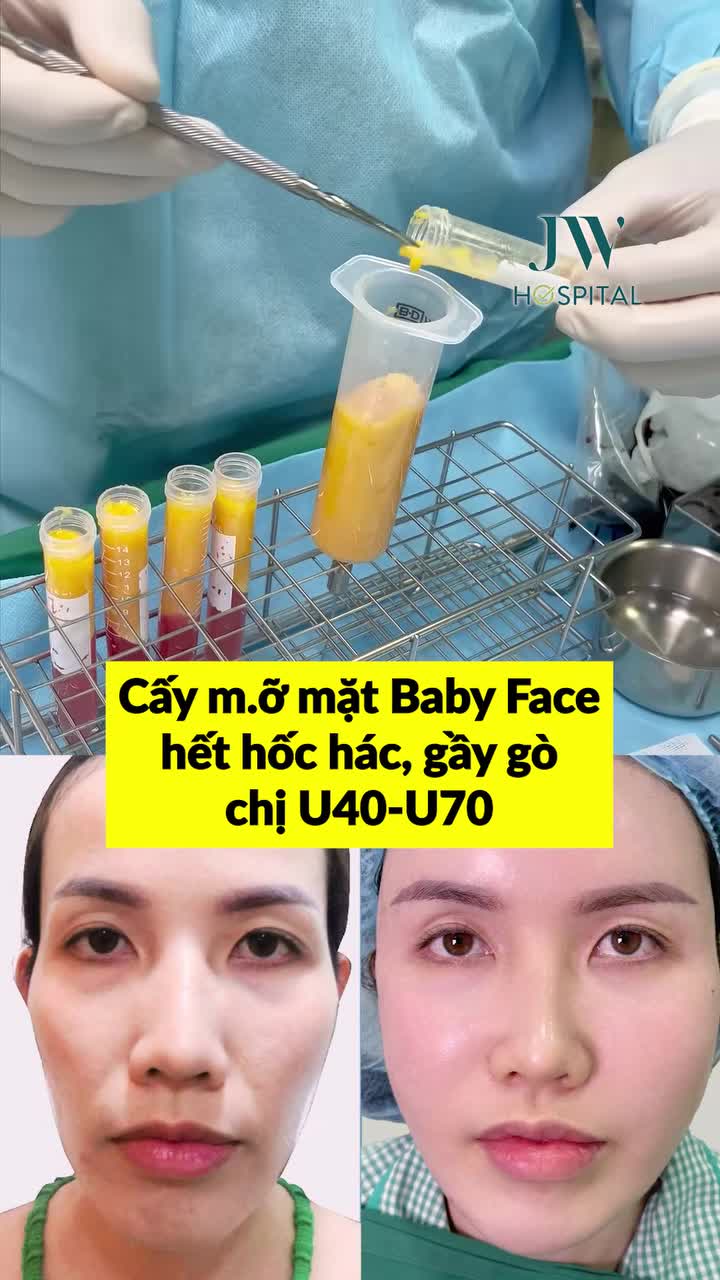 CẤY MỠ MẶT BABY FACE TẠI JW GIÚP CHỊ EM U40-U70 XOÁ MẶT HỐC HÁC, GẦΥ GÒ AN TOÀN KΗÔNG SẸO