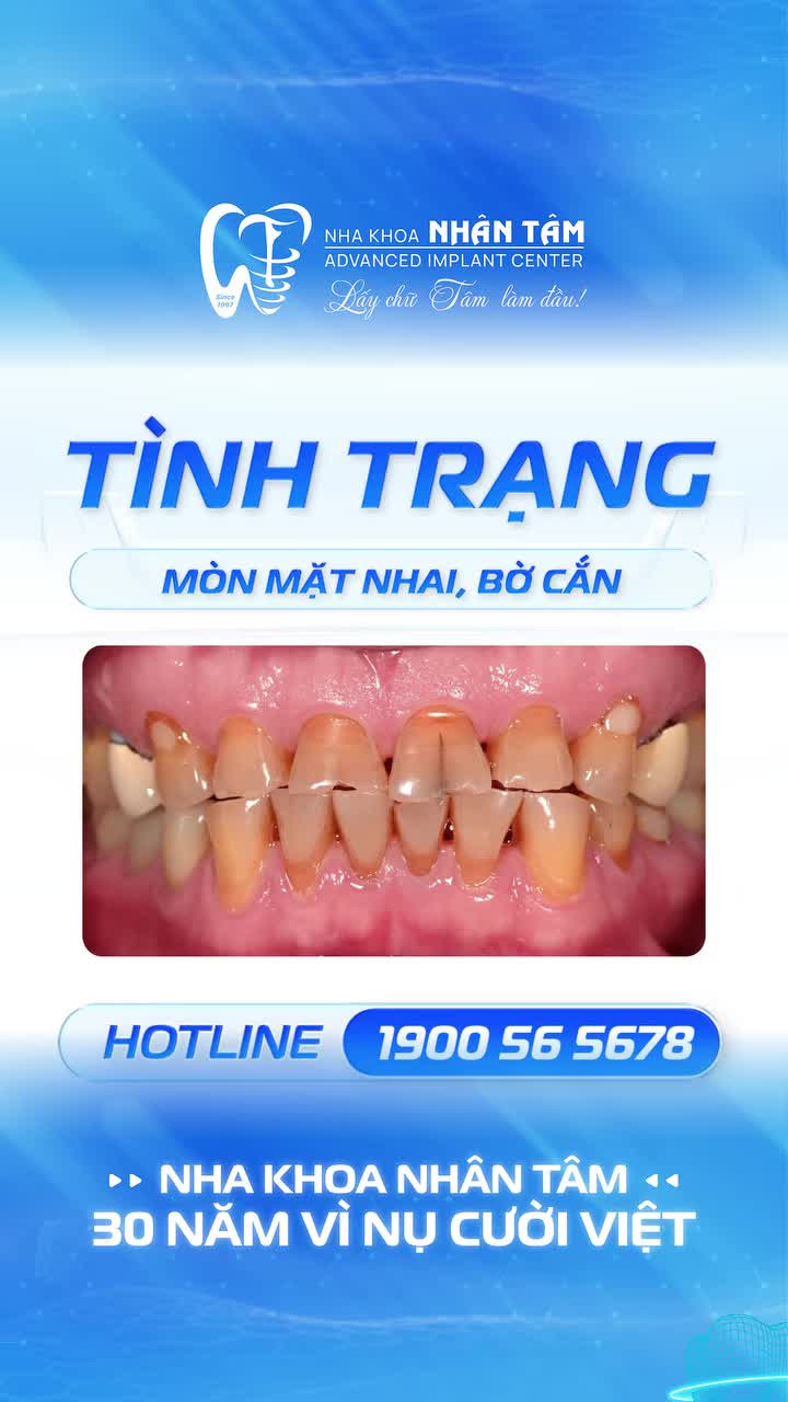 18 RĂNG TOÀN SỨ CHUẨN ĐỨC - THAY ĐỔI DIỆN MẠO NỤ CƯỜI