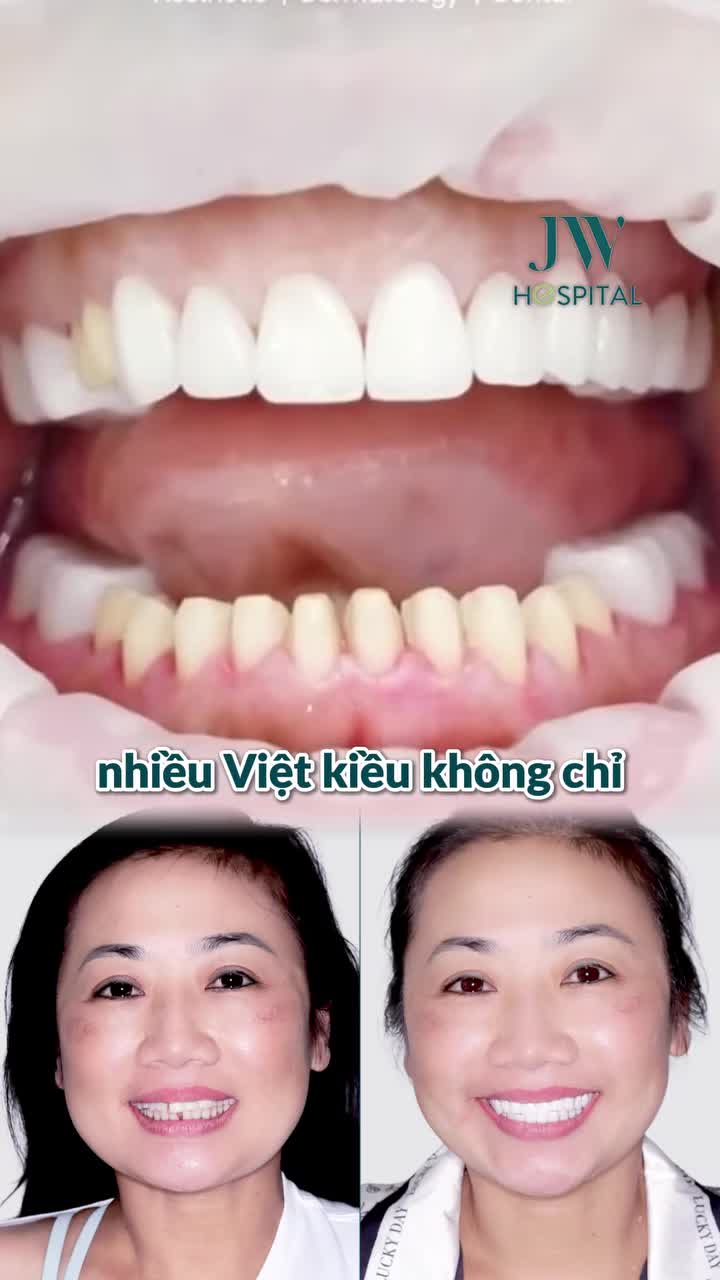 CÔNG KHAI QUY TRÌNH BỌC RĂNG SỨ AN TOÀN CHUẨN Y KHOA CHO VIỆT KIỀU TẠI JW