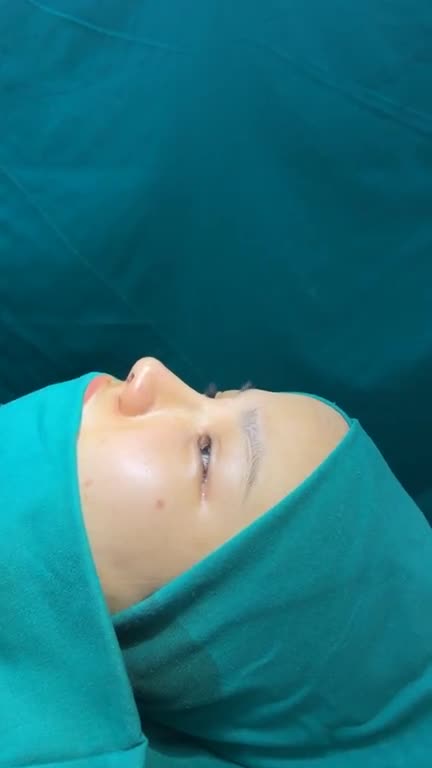 ca nâng mũi cấu trúc