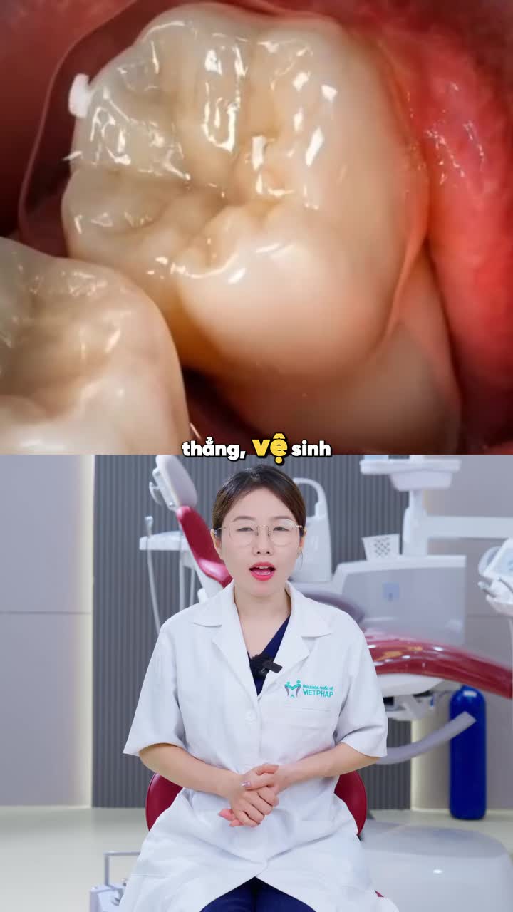 CÓ NHẤT THIẾT PHẢI NHỔ NẾU RĂNG KHÔN KHÔNG ĐAU?