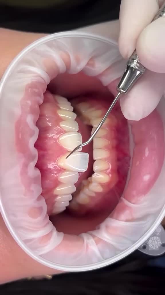 "CẢM GIÁC THỬ MẶT DÁN SỨ VENEER LẦN ĐẦU SẼ NHƯ THẾ NÀO?"
