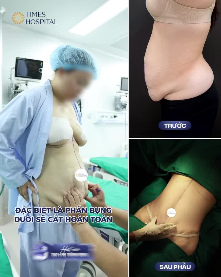 Cận cảnh bước quan trọng quyết định form dáng bụng sau phẫu thuật!