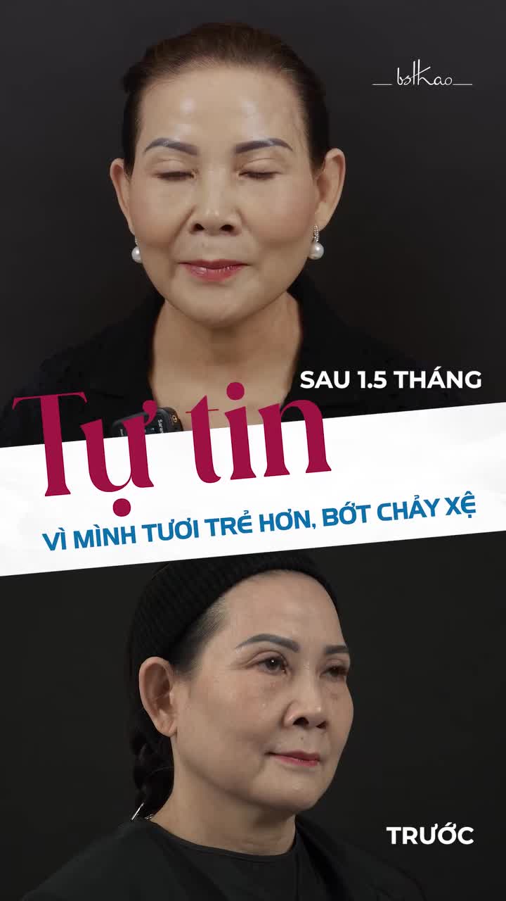 Sau hơn 1 tháng thực hiện 16cc Filler MD Codes, kết quả như thế nào?