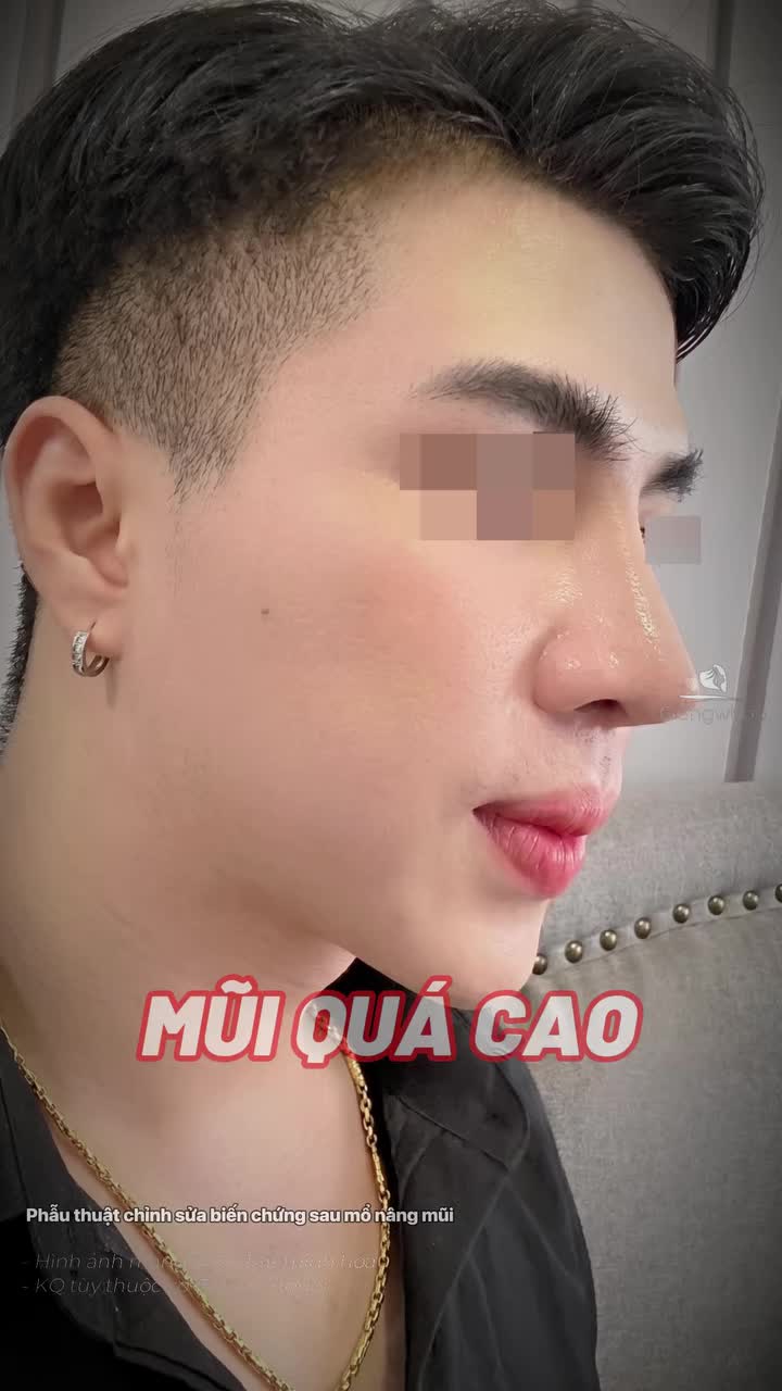 Nâng mũi 3 lần nhưng lần nào cũng cao khiến mũi bị biến chứng và lần này trao trọn niềm tin cho Gangwhoo