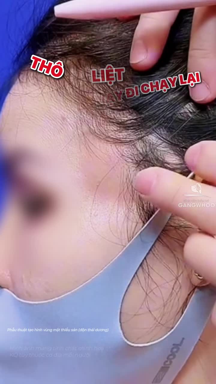 Những biến chứng khiến khách hàng ngần ngại không dám độn thái dương và sự thật tại BVTM Gangwhoo