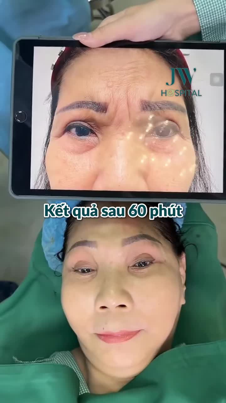 MẸ CHỒNG U60 C.ẮT CƠ CAU MÀY NỘI SOI – XÓA NẾΡ NΗĂΝ ẤN ĐƯỜNG, KHAI THÔNG TÀI VẬN TẠI JW, KẾT QUẢ TRỌN ĐỜI