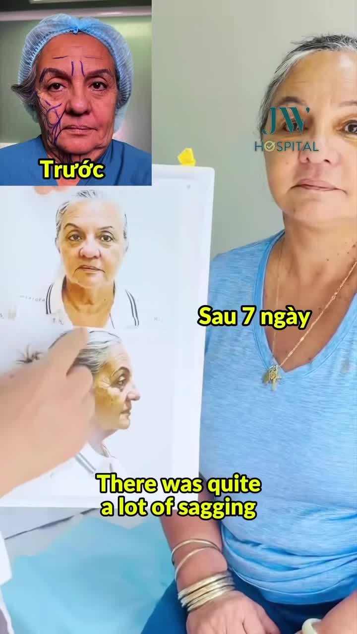 BÁC SĨ TÚ DUNG CĂNG DA MẶT SMAS PRO GIÚP NGƯỜI PHỤ NỮ ÚC 69 TUỔI HỒI XUÂN 20 TUỔI NHÂN DỊP KỶ NIỆM NGÀY CƯỚI