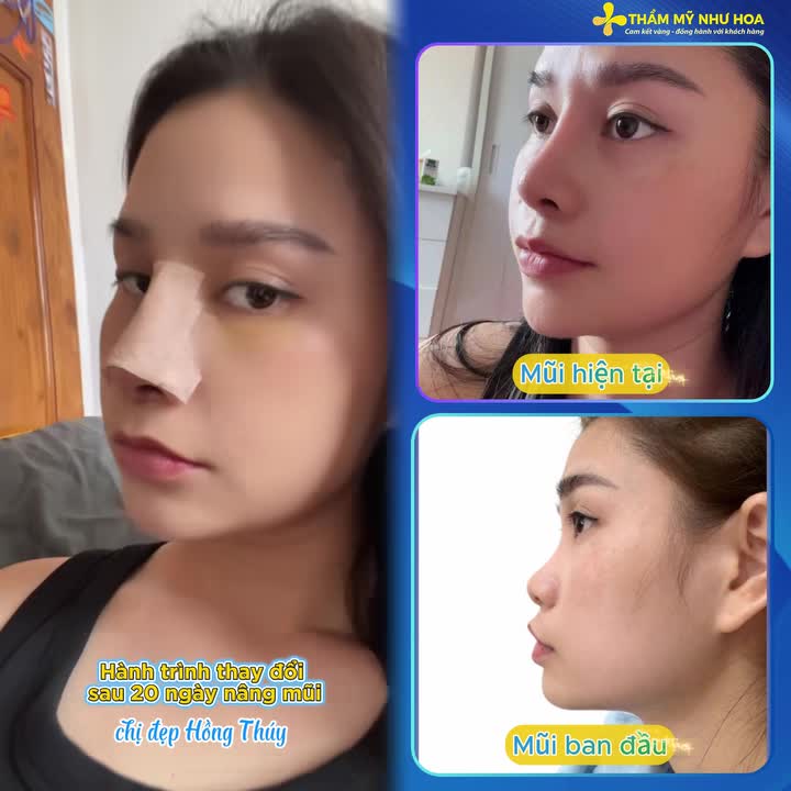 Hành trình sau 20 ngày update visual với nâng mũi Golden Line cùng Tiến sĩ Tống Hải tại Thẩm mỹ Như Hoa