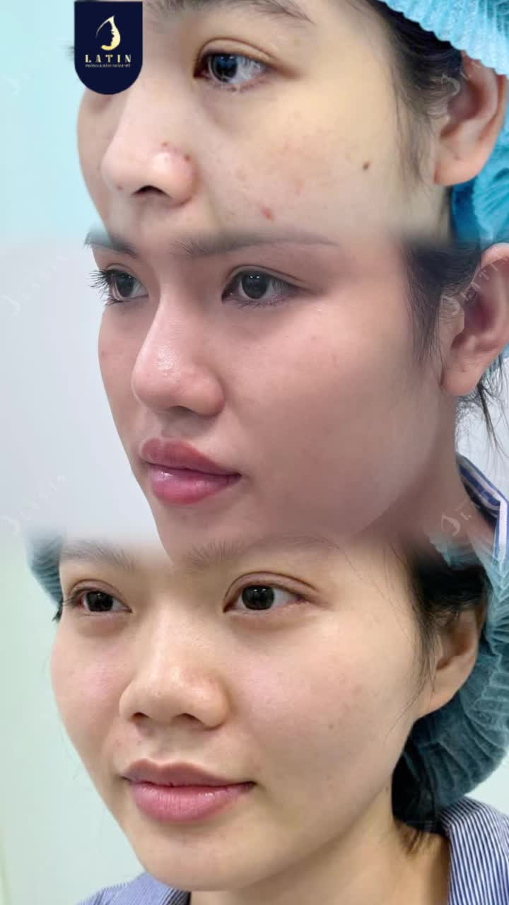 TOP 3 DÁNG MŨI “ĐỔI VẬN” ĐỈNH NHẤT NĂM NAY