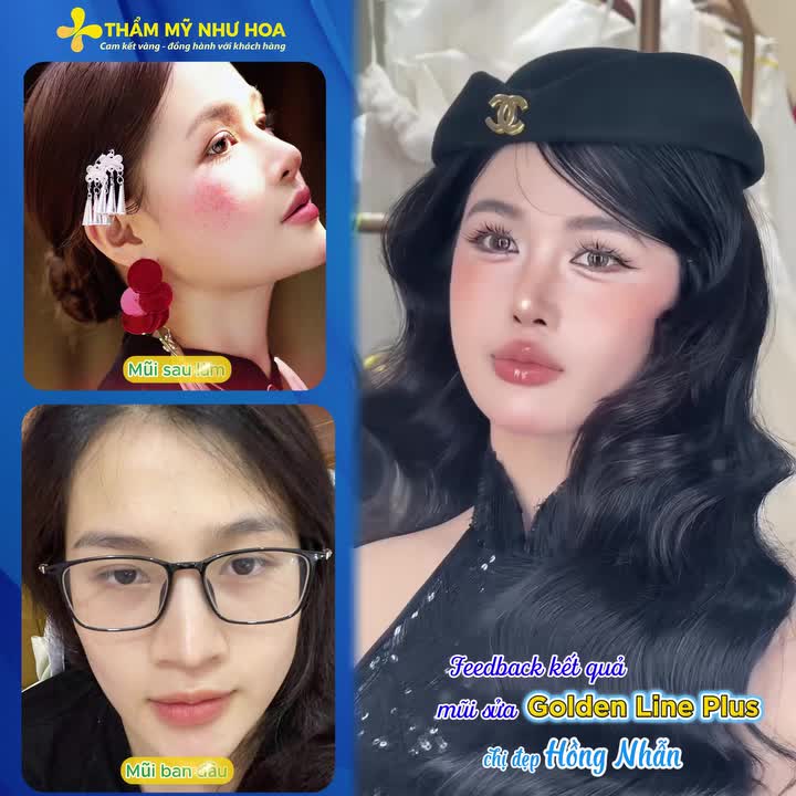 Màn tái sinh đầu mũi nhọn thành dáng mũi tròn đầy, phúc hậu, bền đẹp suốt hơn 2 năm của chị đẹp Hồng Nhẫn sau khi sửa mũi Golden Line Plus cùng Tiến sĩ Tống Hải