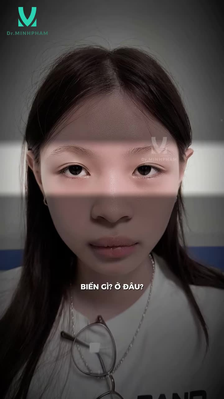 Từ đôi mắt da dư, da chùng, nếp mí không đều