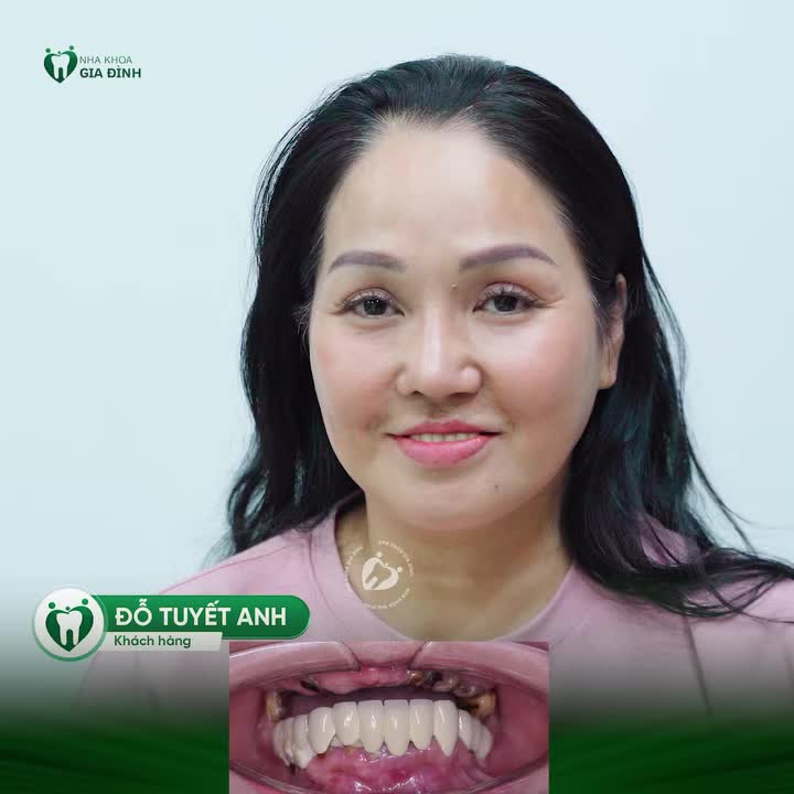 TIẾP NỐI SERIES KHÁCH HÀNG ĐANG CẤY GHÉP IMPLANT TẠI NHA KHOA GIA ĐÌNH