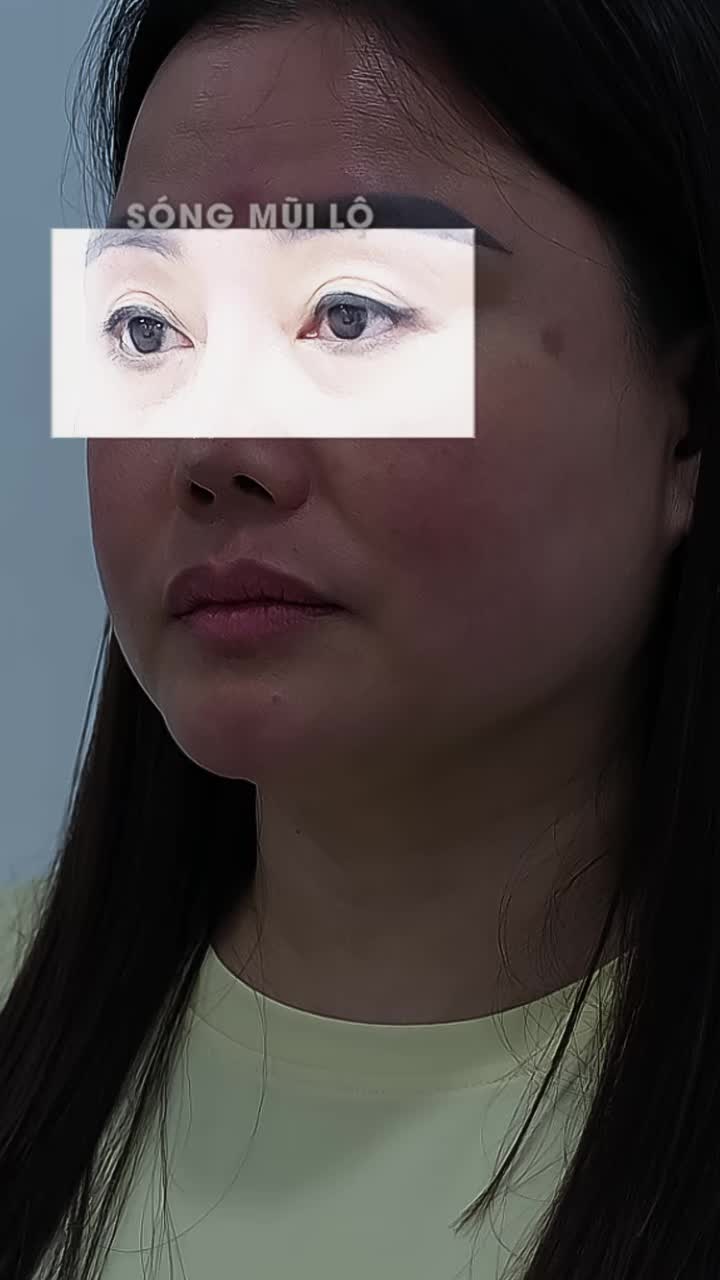 Tình trạng lộ sóng và đầu mũi mỏng dù chỉ mới nâng mũi được 5 năm đã khiến dáng mũi của chị không còn đẹp như trước.