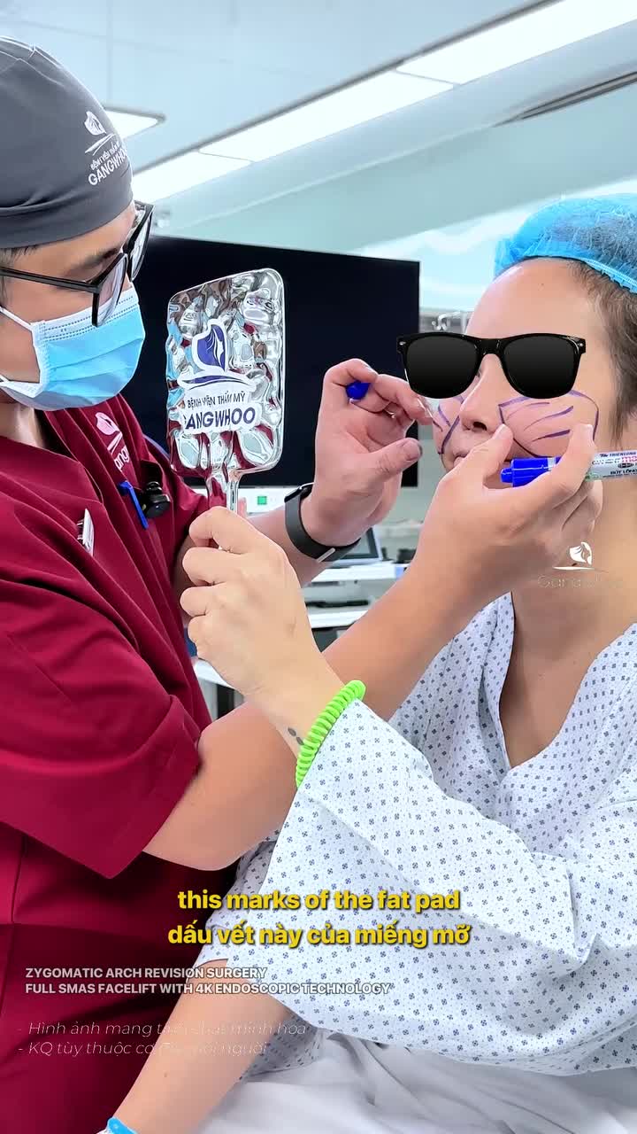 Vừa gò má cao - vừa da chảy xệ thì làm thế nào để cải thiện đường nét?