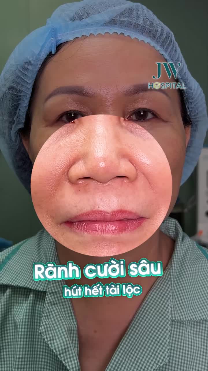 ƯU TIÊN CHỊ EM U40–U70: XOÁ BỌNG MẮT TO, RÃNH CƯỜI SÂU VỚI MIDFACE 3 IN 1 TẠI JW TRẺ 20 TUỔI
