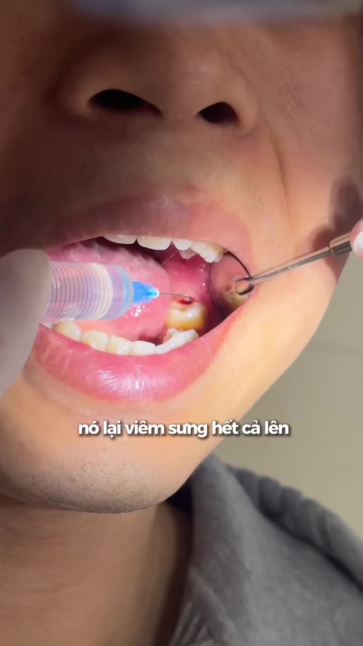 Có bạn nào đang gặp tình trạng như này không? Đến Viet Smile để được bác sĩ thăm khám và tư vấn nhé!