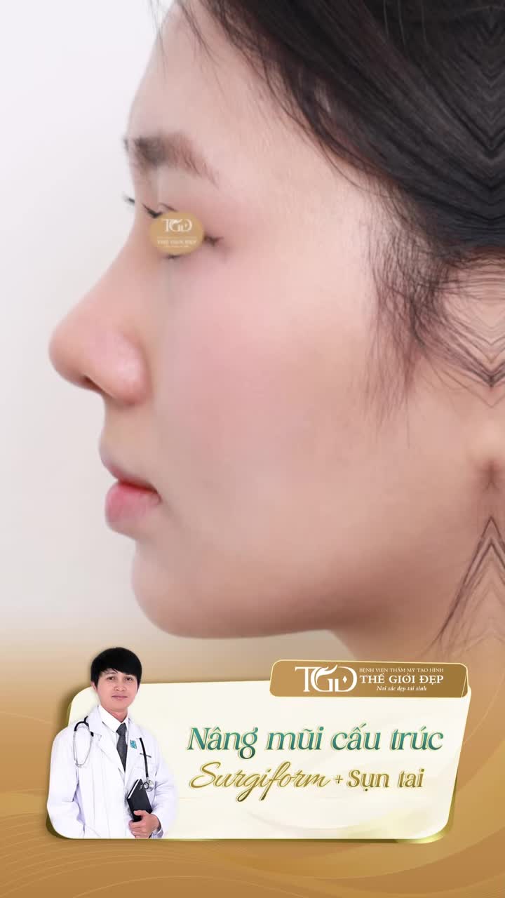 Sụn tai có thể thay đổi dáng mũi như thế nào
