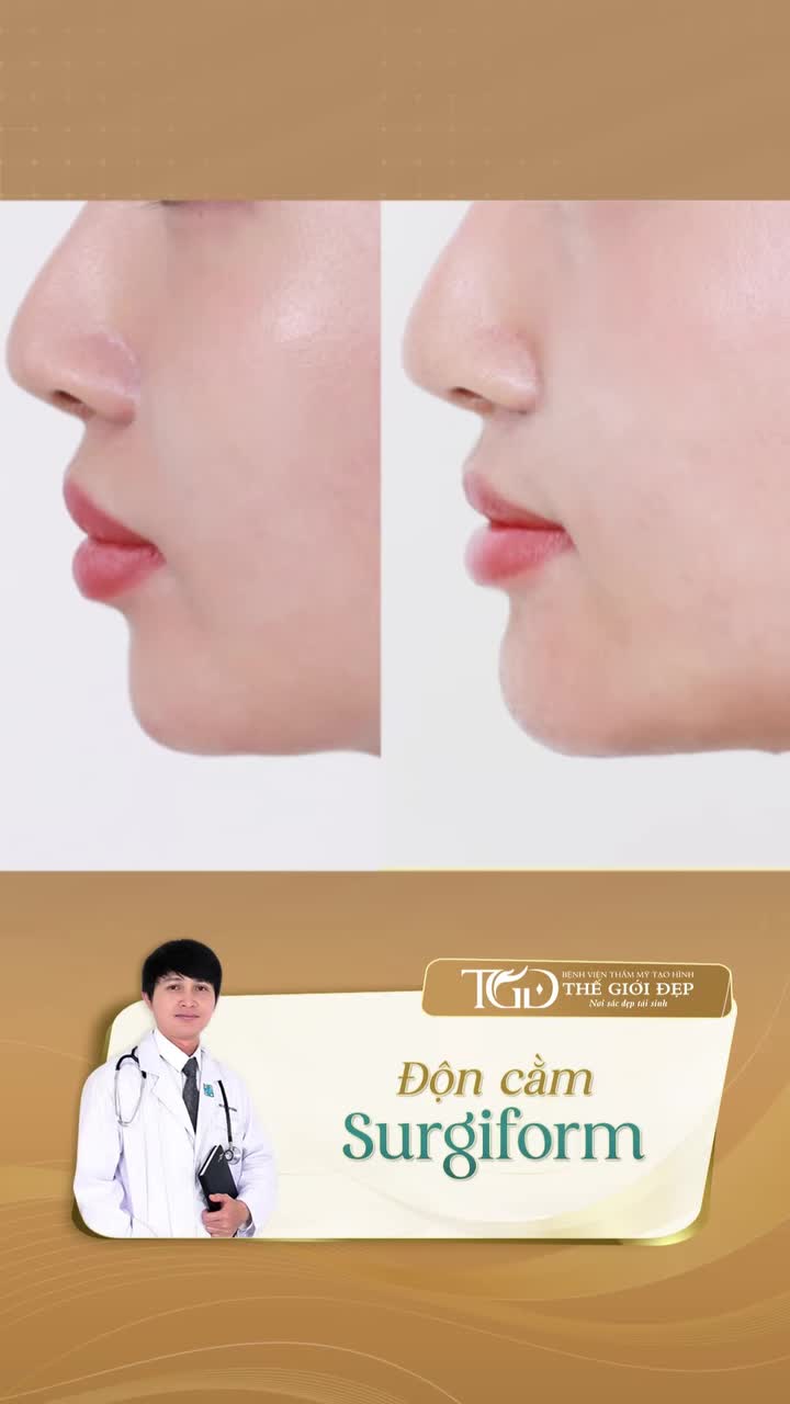 Cằm lồi lõm do filler – Tái tạo dáng cằm chuẩn Vline bằng sụn sinh học cao cấp