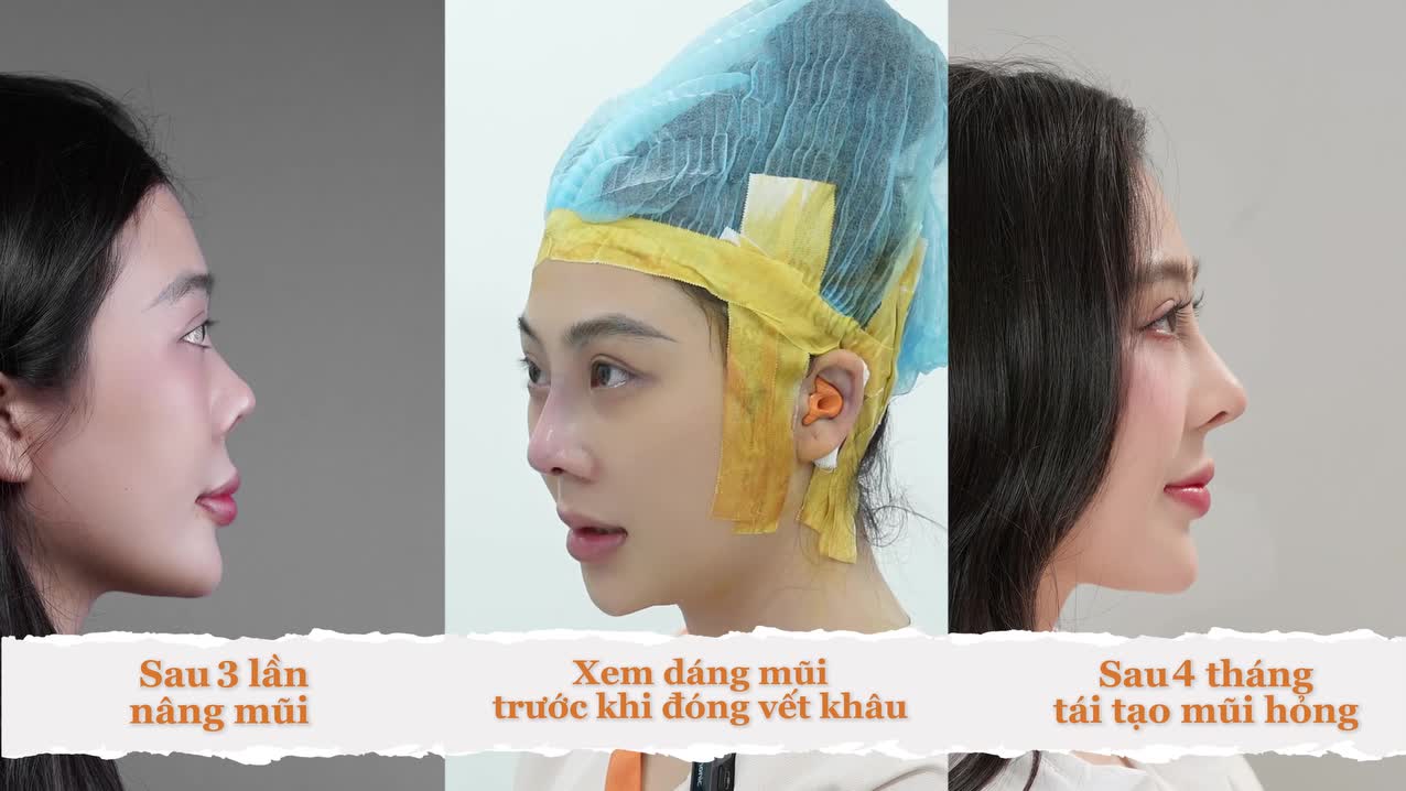 Khắc phục tình trạng mũi ngắn, h.ếch sau 3 lần nâng mũi cho khách hàng 2K.