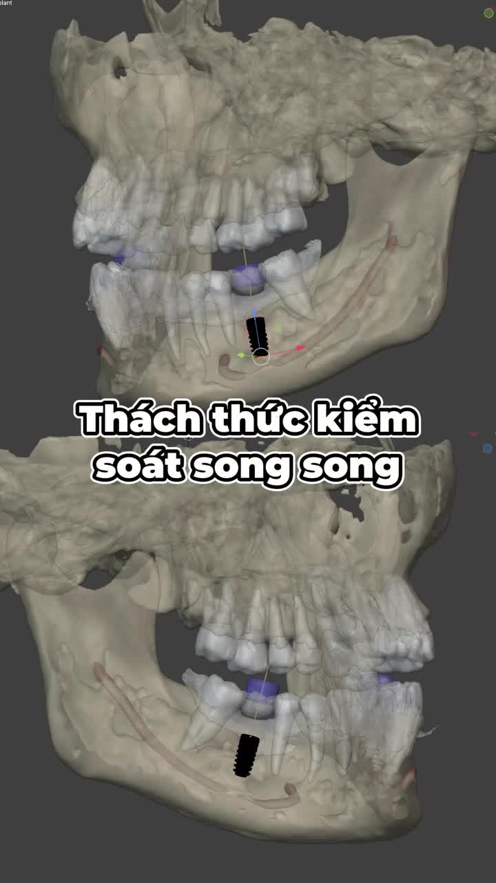MẤT CÙNG LÚC HAI RĂNG SỐ 6 HÀM DƯỚI – CÓ THỂ KIỂM SOÁT CẢ HAI VỊ TRÍ IMPLANT TRONG CÙNG MỘT CASE PHẪU THUẬT?