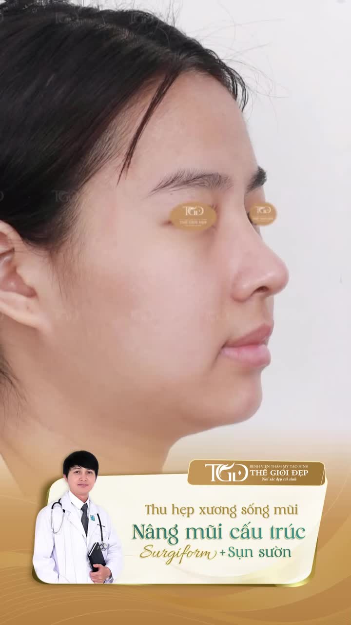 Định hình sống mũi hài hòa, thanh thoát với Nâng mũi cấu trúc sụn sườn + Thu hẹp xương sống mũi