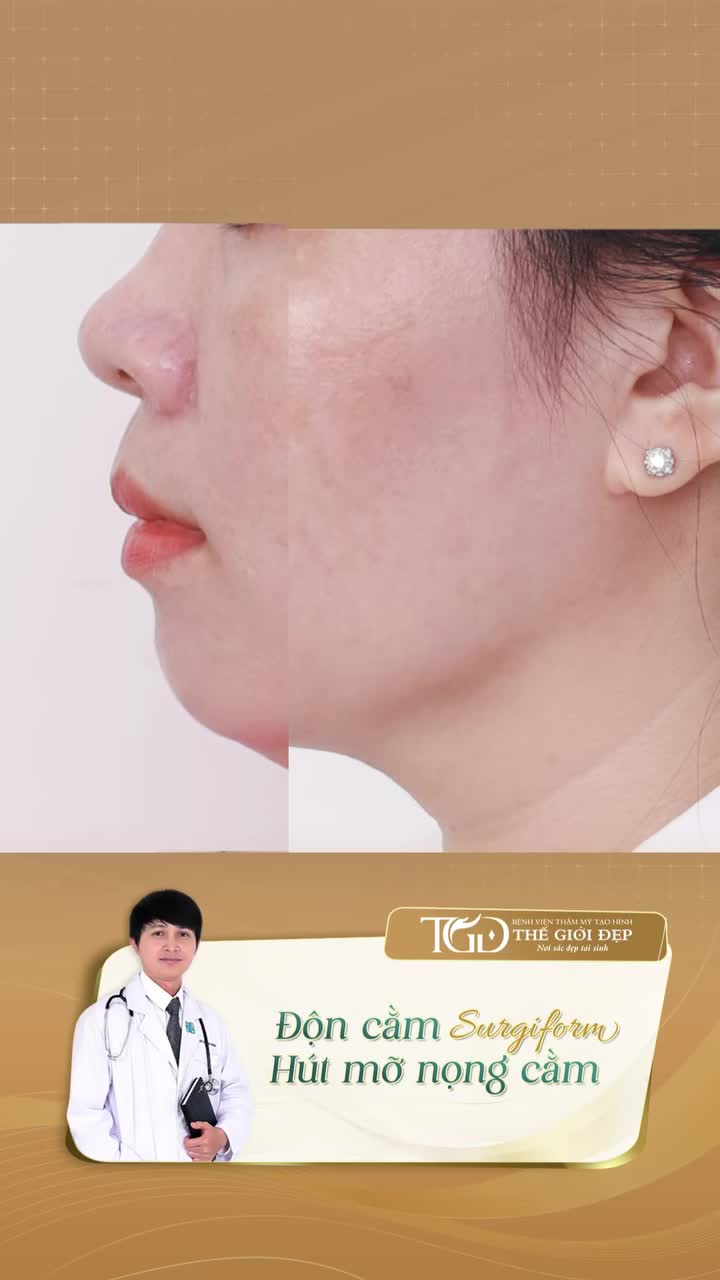 Cằm lẹm, nọng cằm nhiều: Vì sao chỉ độn cằm chưa chắc đã đủ đẹp?