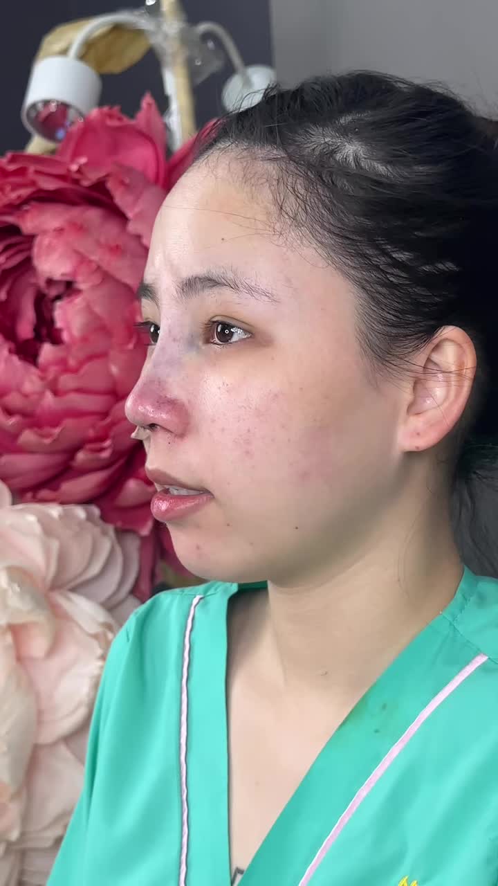 Case mũi cấu trúc vừa hoàn thành