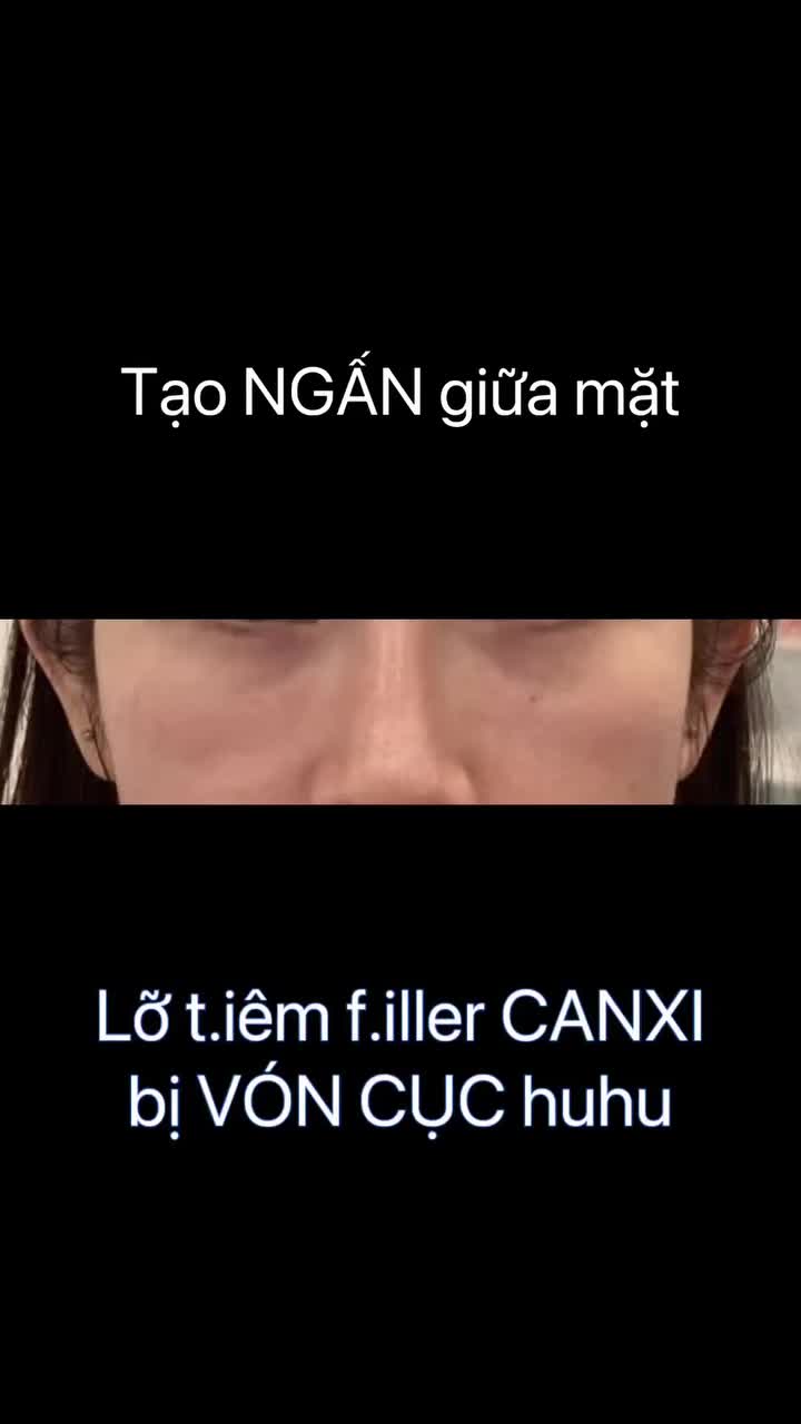 LỠ TIÊM FILLER CANXI VÀO MẮT DƯỚI NÊN BỊ PHÌNH LÊN KHI CƯỜI THÌ CẢI THIỆN THẾ NÀO?