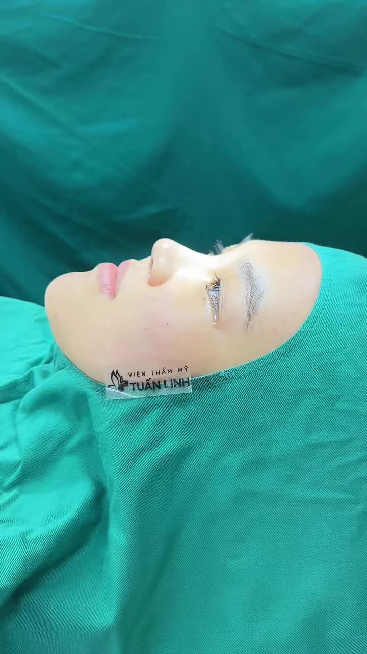 Mũi bọc sụn sau phẫu thuật