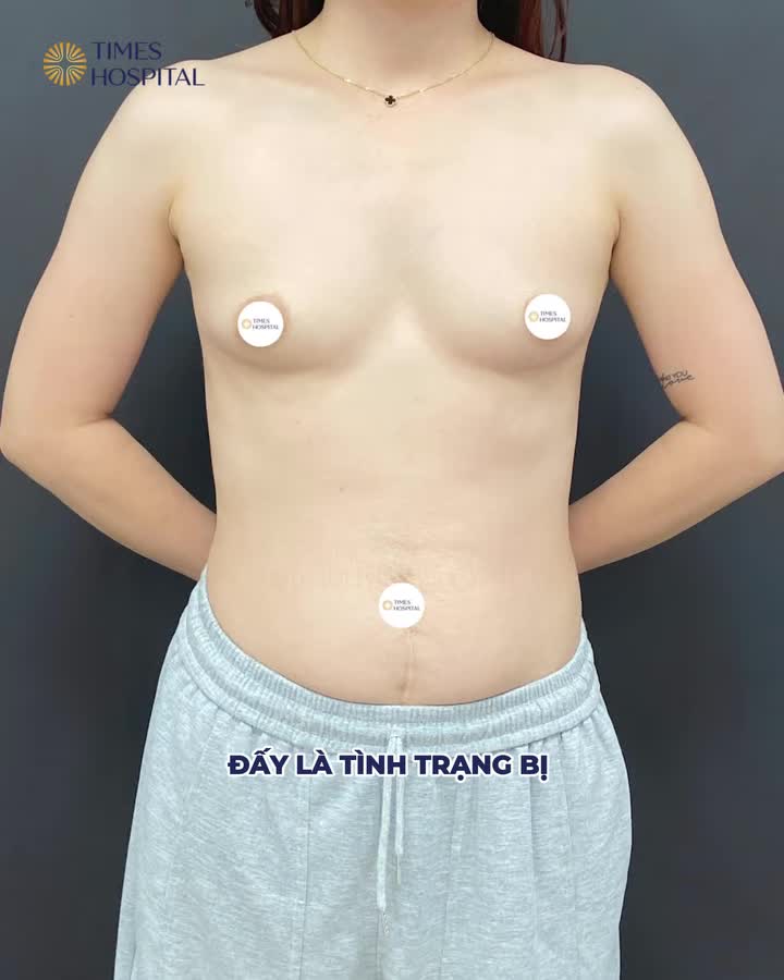 CA NÂNG NGỰC CHO KHÁCH HÀNG TEO LÉP SAU SINH