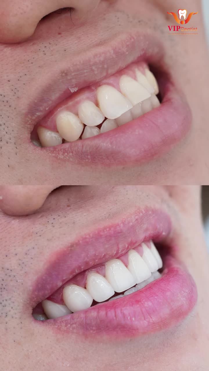 Xem thêm 95 video Bọc Răng Sứ của bác sĩ Bs nha khoa Vip Dentist