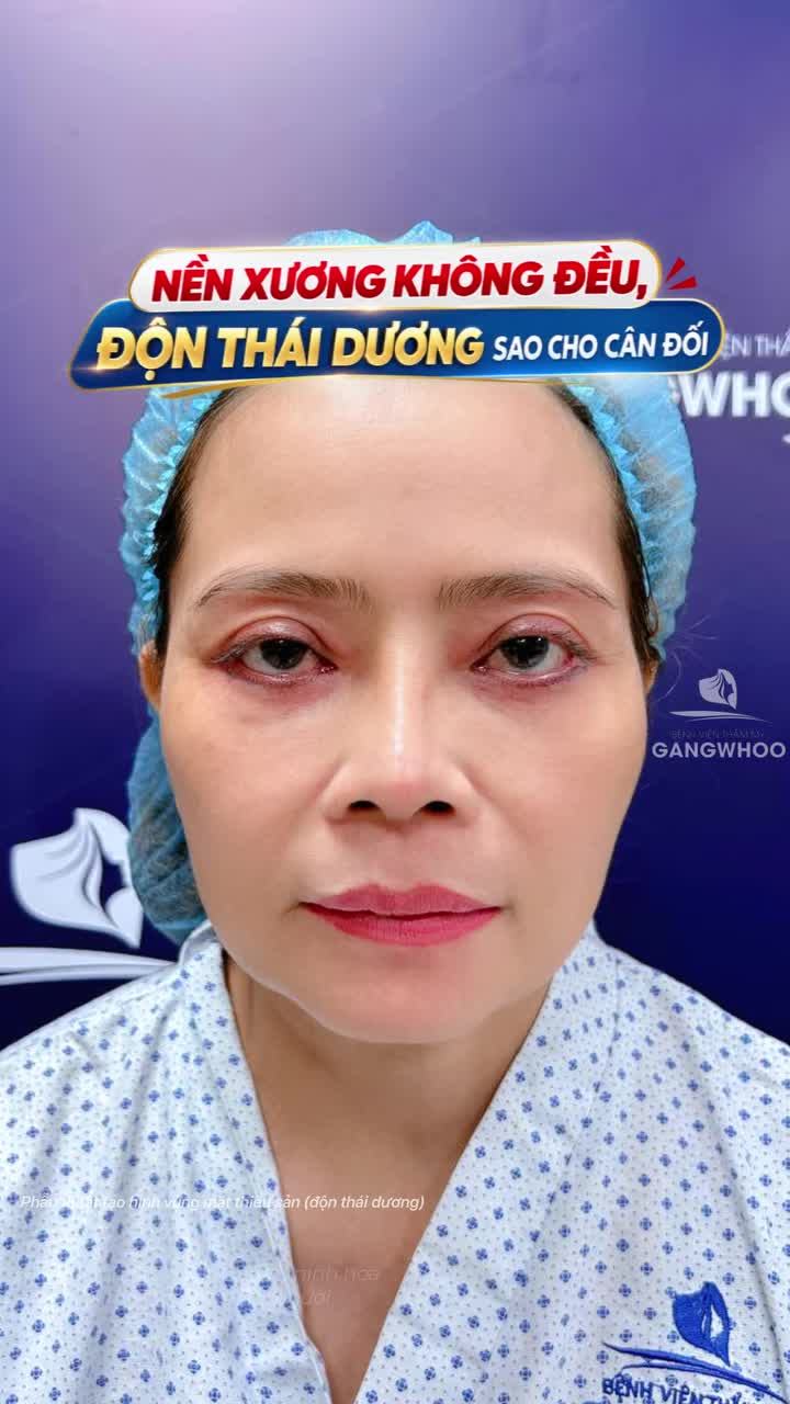 Nền xương không đều, độn thái dương sao cho cân đối?