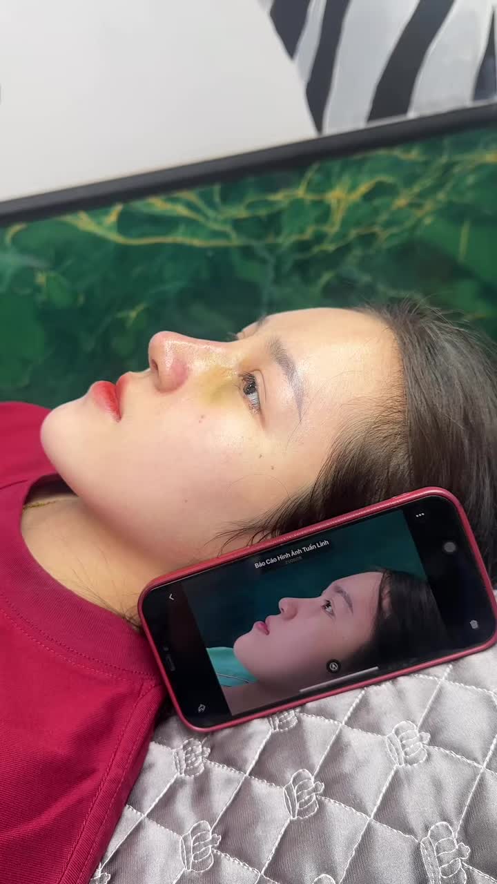 Mũi bọc sụn sau 10 ngày
